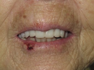 After extraction and denture